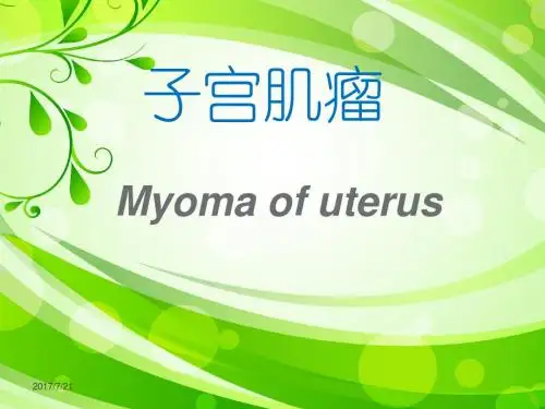 子宫肌瘤  ppt课件