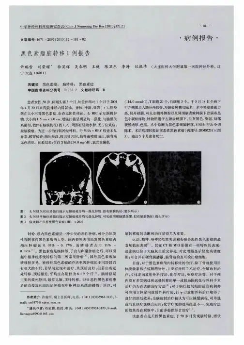 黑色素瘤脑转移1例报告