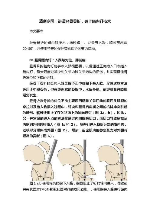 清晰多图！讲清胫骨骨折，髌上髓内钉技术