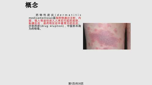 药  疹护理查房PPT课件