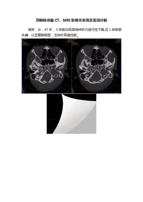 颈静脉球瘤CT、MRI影像变表现及鉴别诊断