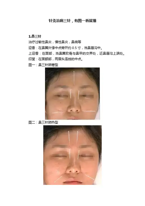 针灸治病三针，有图一看就懂