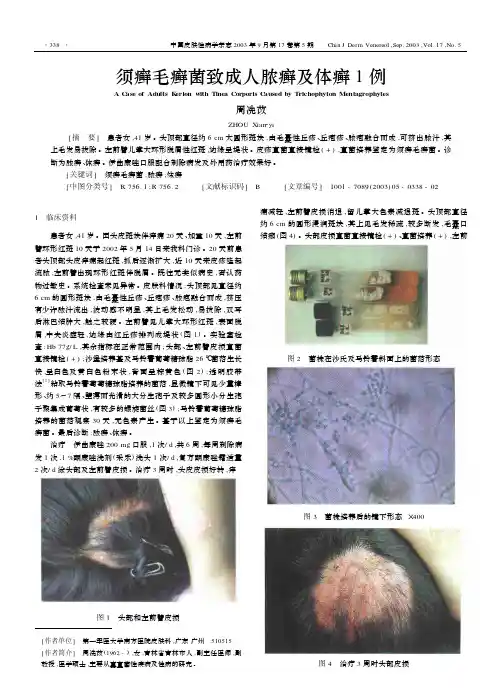 须癣毛癣菌致成人脓癣及体癣1例.pdf