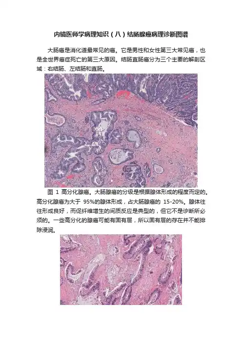 内镜医师学病理知识（八）结肠腺癌病理诊断图谱