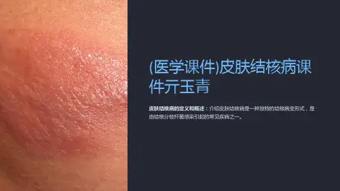 (医学课件)皮肤结核病课件亓玉青