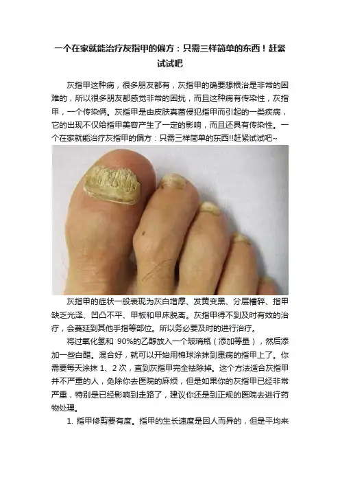 一个在家就能治疗灰指甲的偏方：只需三样简单的东西！赶紧试试吧