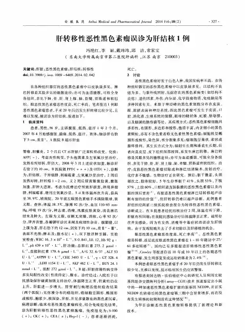 肝转移性恶性黑色素瘤误诊为肝结核1例