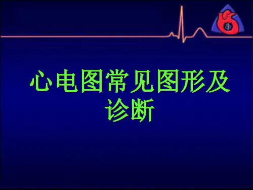 心电图常见波形及诊断