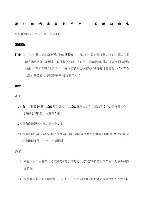 聚桂醇泡沫硬化治疗下肢静脉曲张