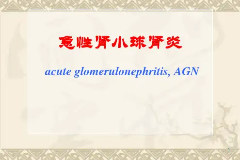 急性肾小球肾炎 PPT课件