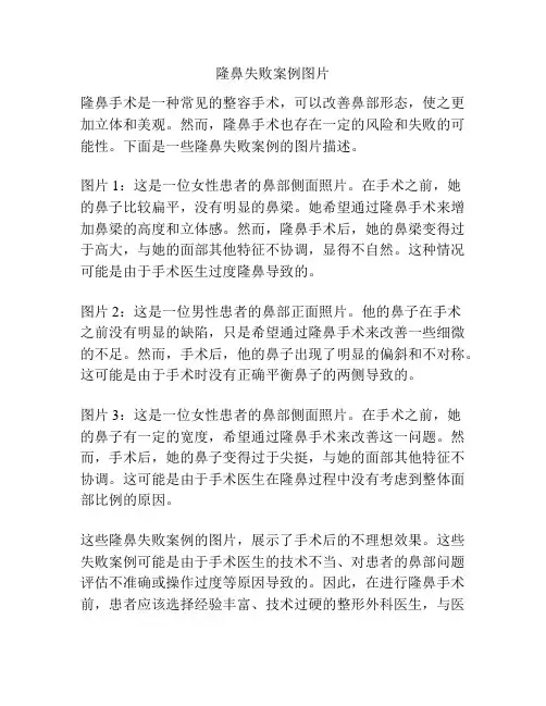 隆鼻失败案例图片