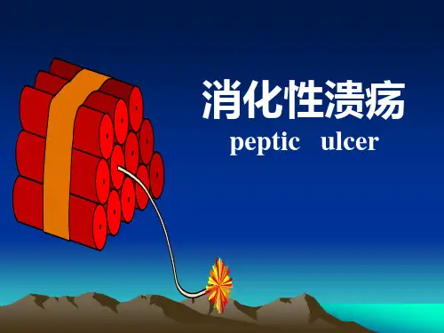 消化性溃疡ppt课件