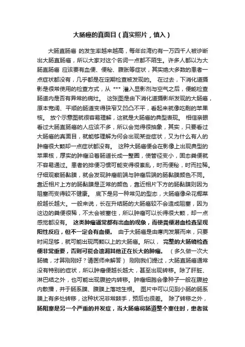 大肠癌的真面目（真实照片，慎入）