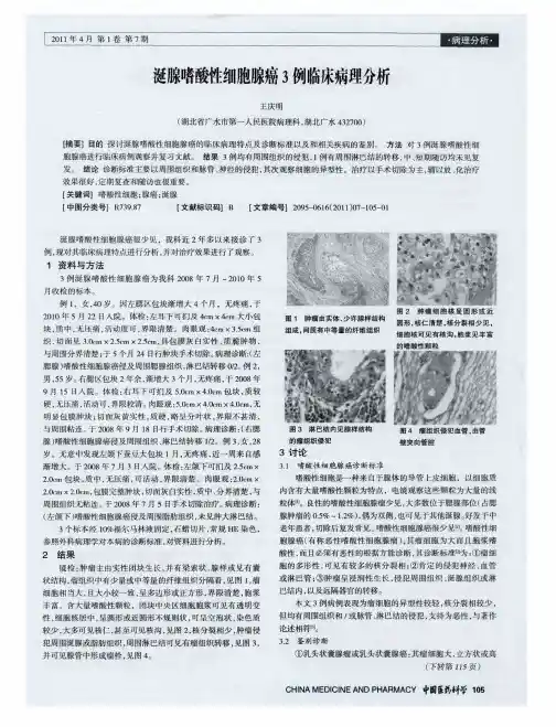涎腺嗜酸性细胞腺癌3例临床病理分析