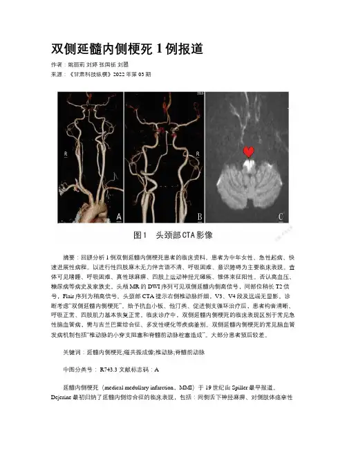 双侧延髓内侧梗死1例报道