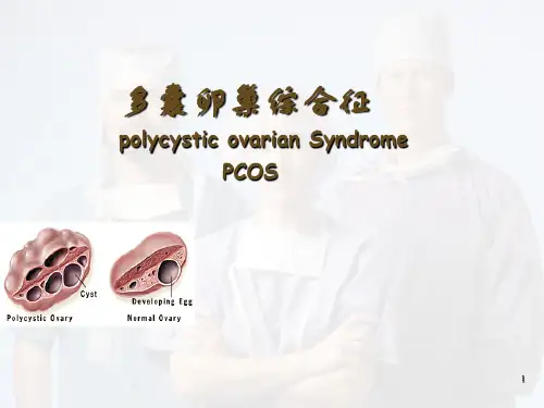 多囊卵巢综合征PPT医学课件