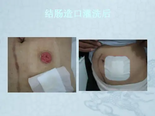 结肠造口灌洗