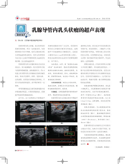 乳腺导管内乳头状瘤的超声表现