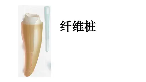 纤维桩
