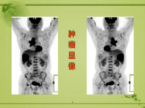 肿瘤显像_精品文档