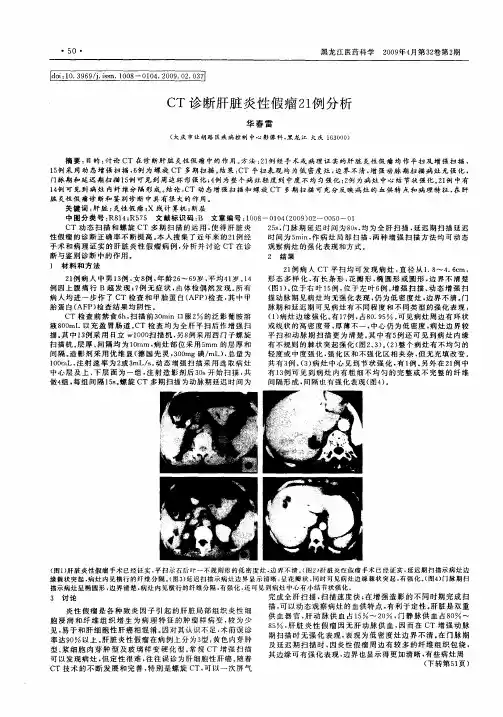 CT诊断肝脏炎性假瘤21例分析