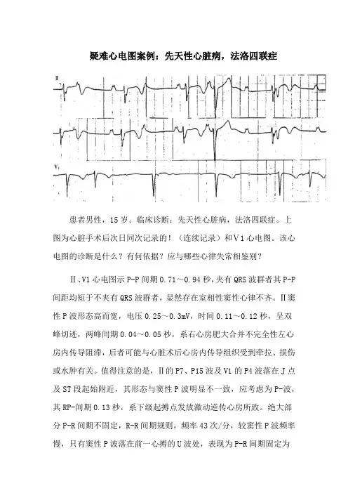 疑难心电图案例：先天性心脏病,法洛四联症
