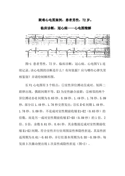 疑难心电图案例：患者男性,72岁。临床诊断：冠心病——心电图精解