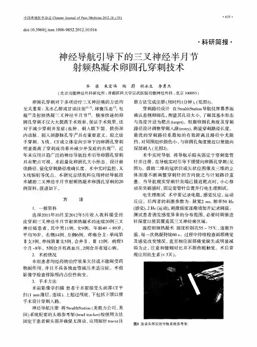 神经导航引导下的三叉神经半月节射频热凝术卵圆孔穿刺技术