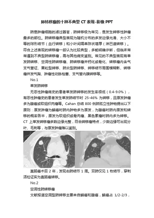 肺转移瘤的十种不典型CT表现–影像PPT