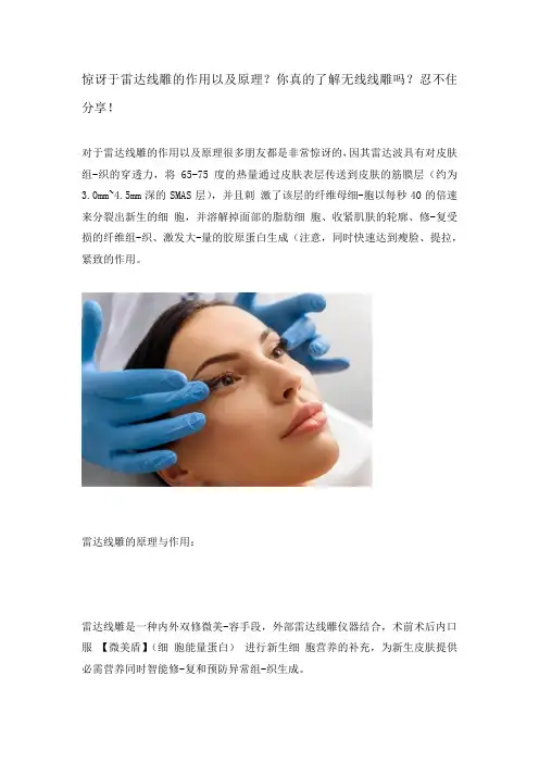 雷达线雕的作用以及原理