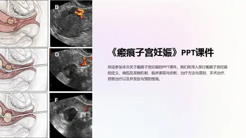 《瘢痕子宫妊娠》课件