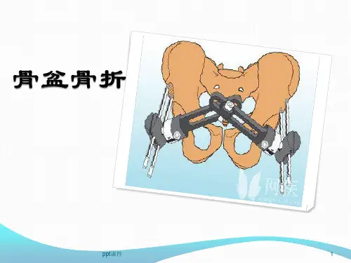 骨盆骨折分型、治疗及康复  ppt课件