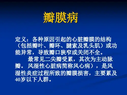 二尖瓣狭窄