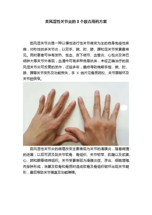 类风湿性关节炎的3个联合用药方案