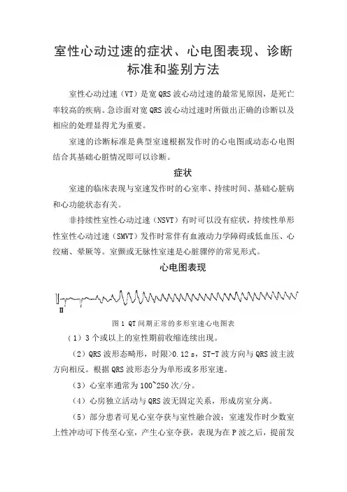 室性心动过速的症状、心电图表现、诊断标准和鉴别方法
