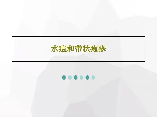 水痘和带状疱疹56页PPT