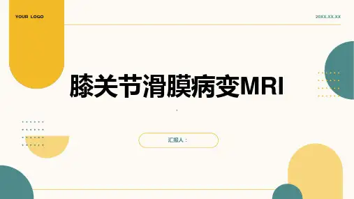 膝关节滑膜病变MRI
