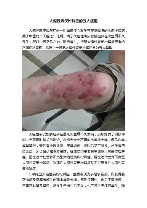 大疱性表皮松解症的五大症型
