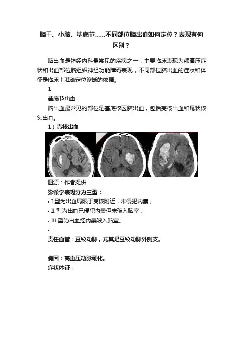 脑干、小脑、基底节......不同部位脑出血如何定位？表现有何区别？
