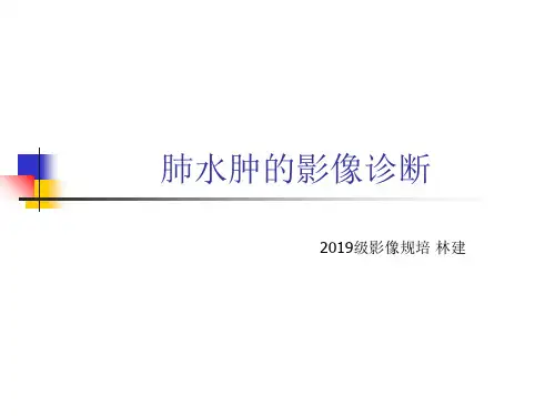 肺水肿的影像诊断-63页PPT文档资料