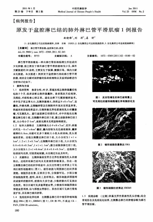 原发于盆腔淋巴结的肺外淋巴管平滑肌瘤1例报告