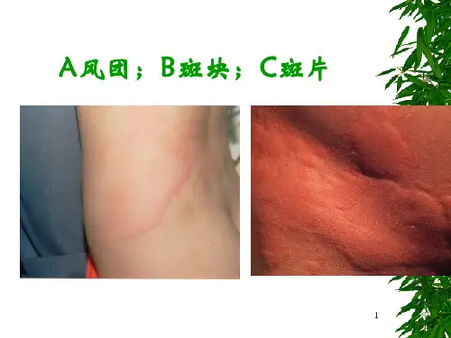 荨麻疹 PPT课件