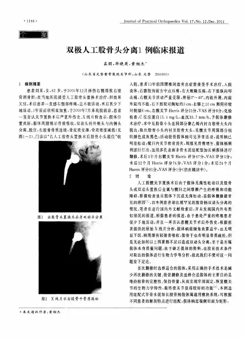 双极人工股骨头分离1例临床报道