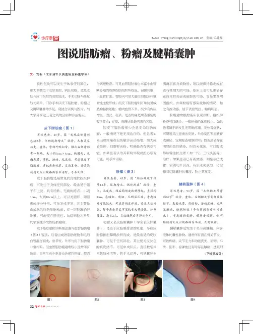 图说脂肪瘤、粉瘤及腱鞘囊肿
