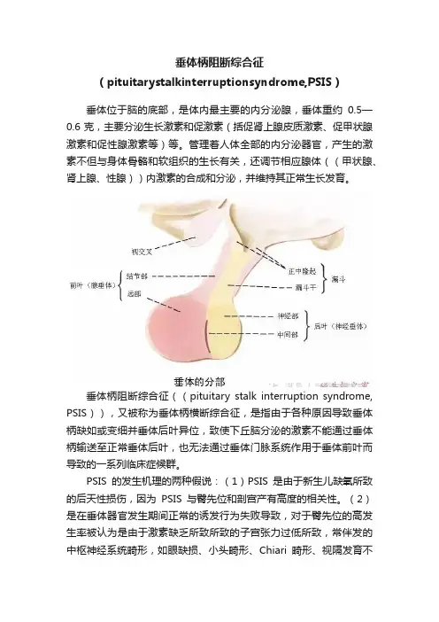 垂体柄阻断综合征（pituitarystalkinterruptionsyndrome,PSIS）