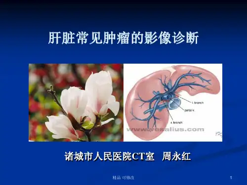 肝脏肿瘤的影像诊断精品课件