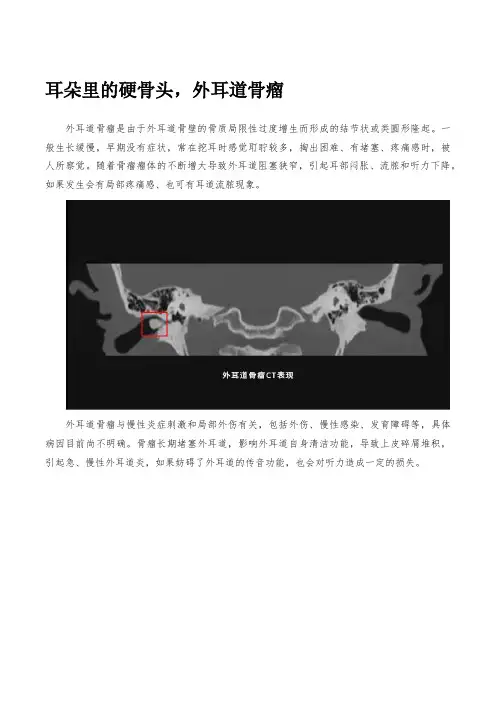 外耳道骨瘤——耳朵里的硬骨头,要注意了