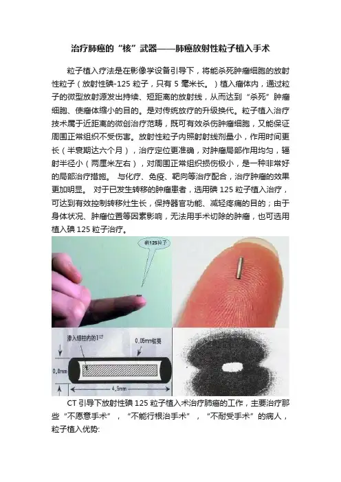 治疗肺癌的“核”武器——肺癌放射性粒子植入手术