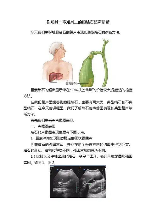你知其一不知其二的胆结石超声诊断