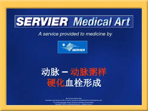 动脉粥样硬化精美图片